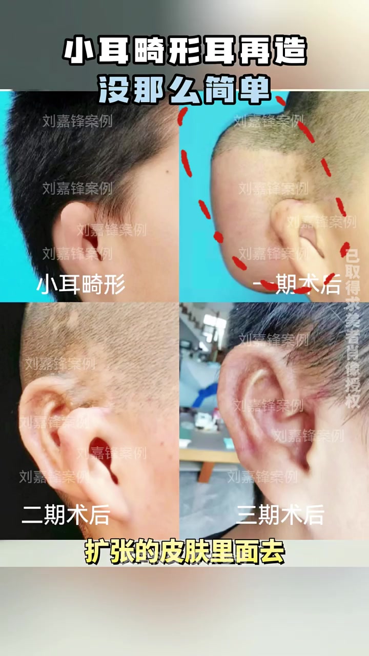 小耳畸形耳再造没那么简单 小耳畸形 同济刘嘉峰