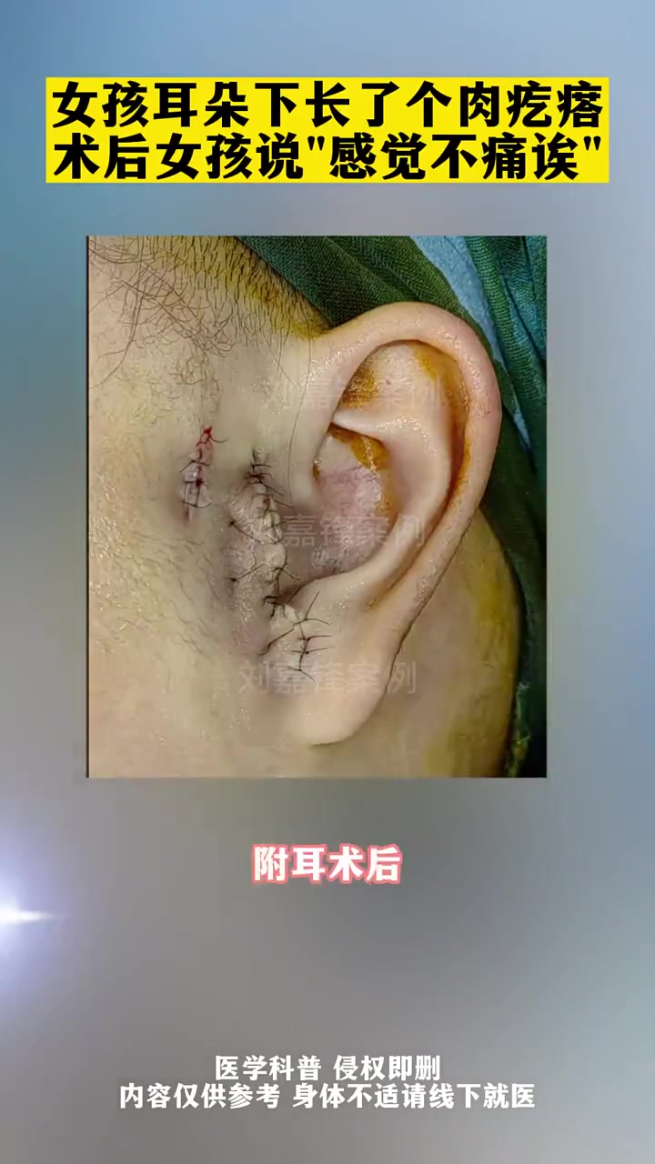 第55集|女孩耳朵下面长了一个肉疙瘩,术后女孩对我说:感觉不是很痛呀