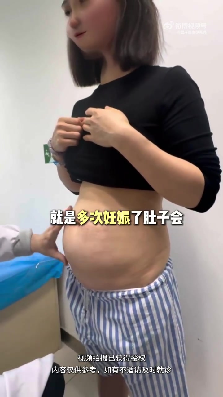 四胎宝妈悬浮肚,全腹壁整形改变