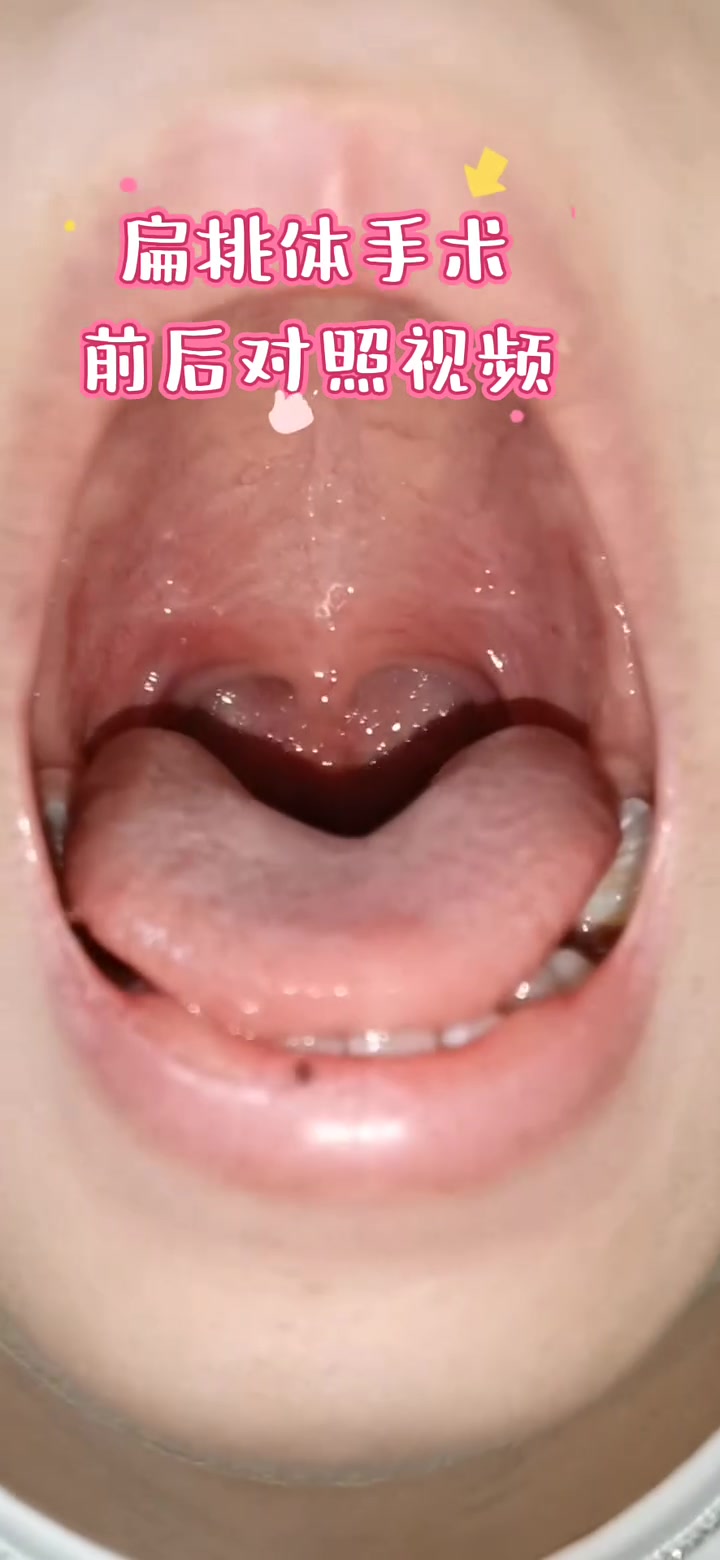 扁桃体手术前后对比,有的人根本看不出来孩子已经做过手术了!