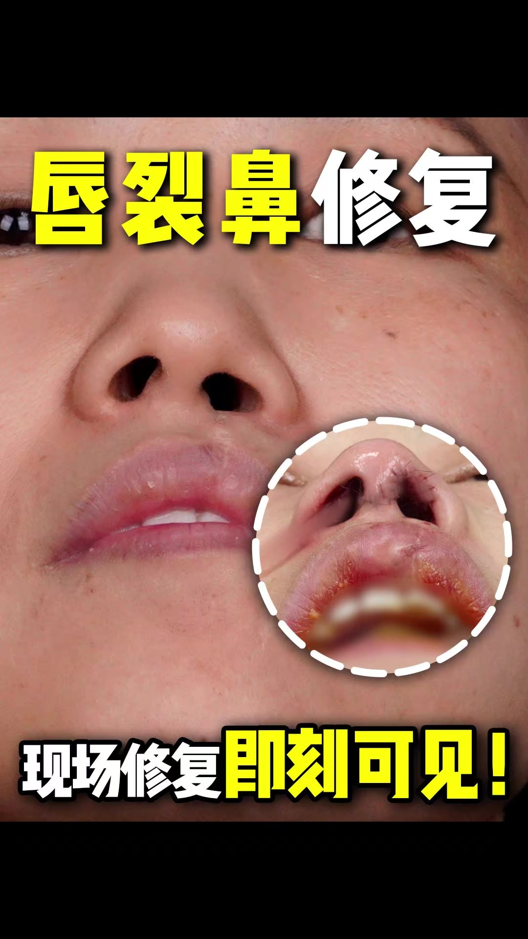 唇裂鼻修复,现场修复即刻可见!