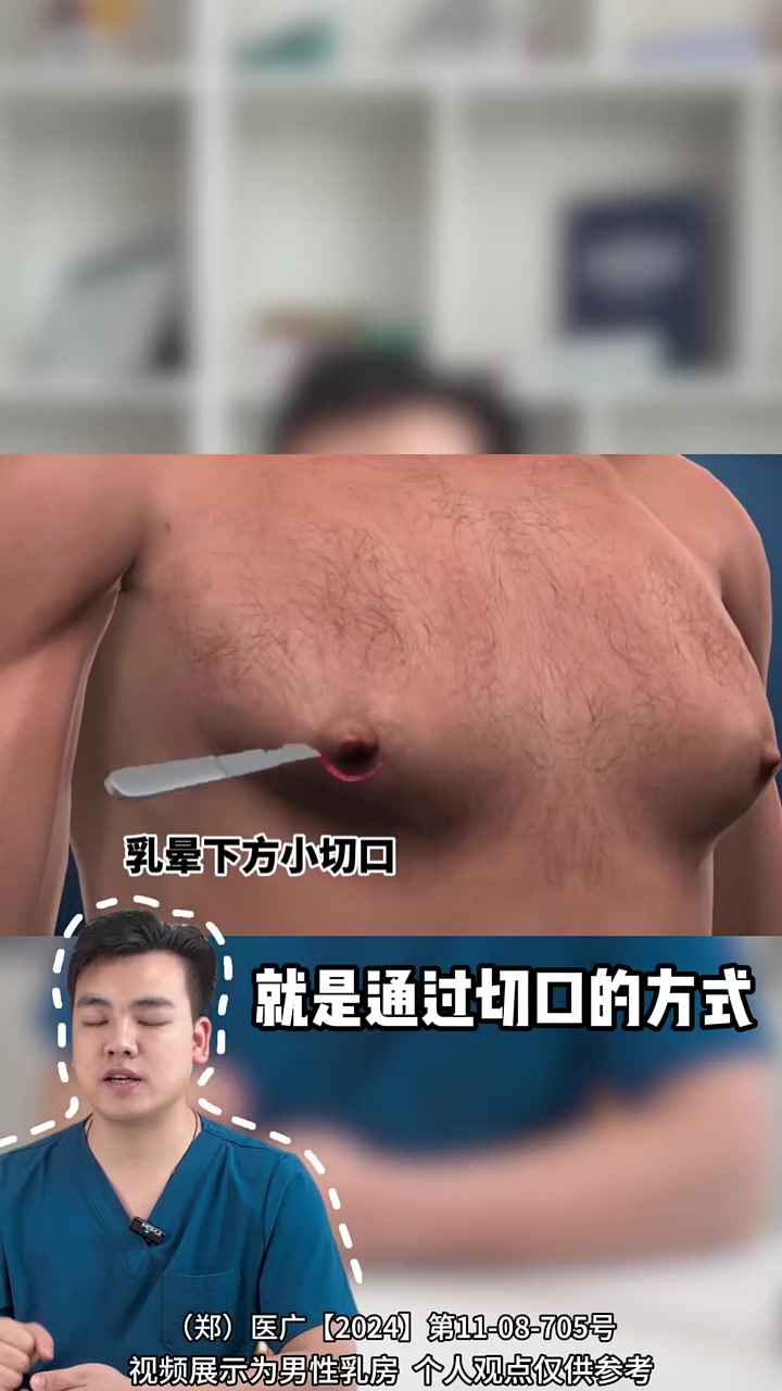 雌化胸 变美 男乳