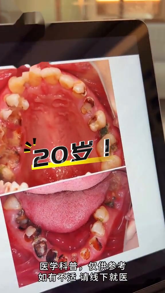 牙齿为什么会烂 牙齿为什么会烂