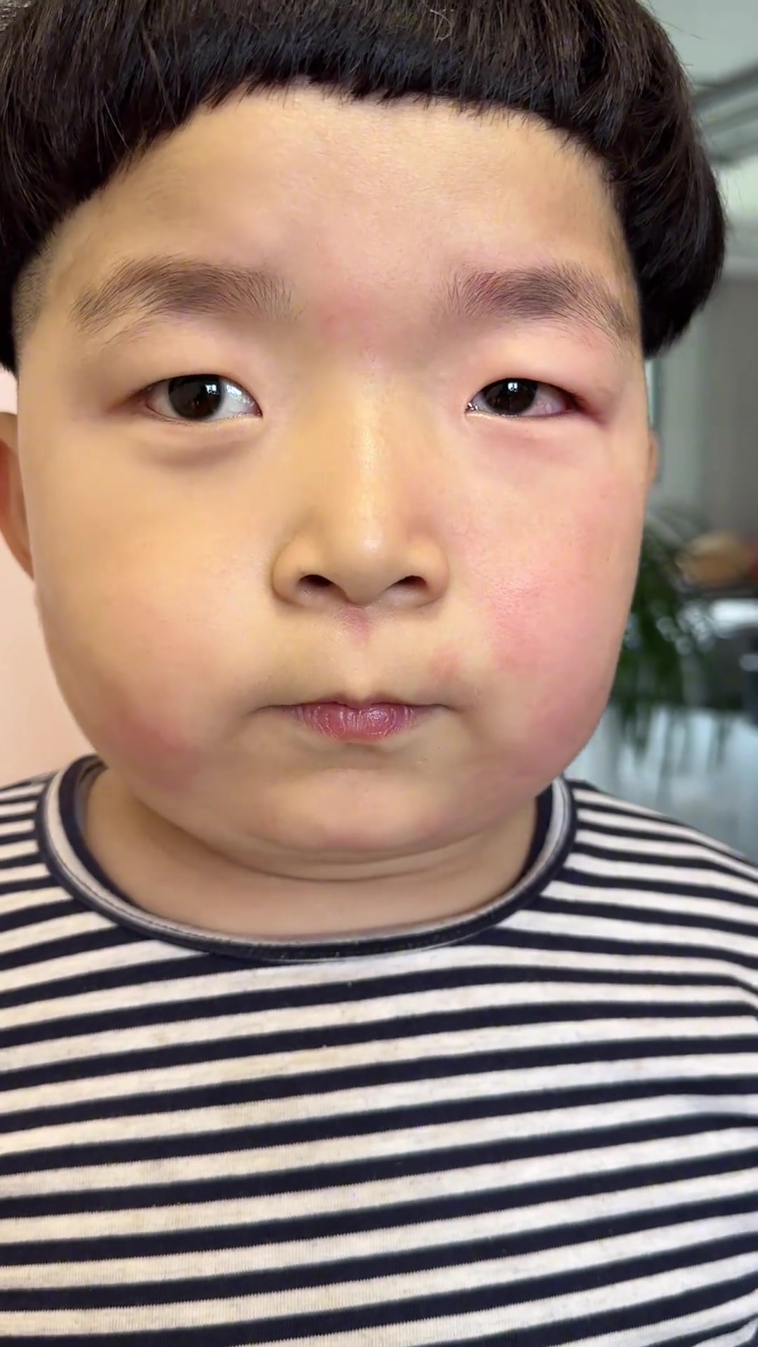 桃子过敏好了伤疤忘了疼,捡食桃子后又过敏了