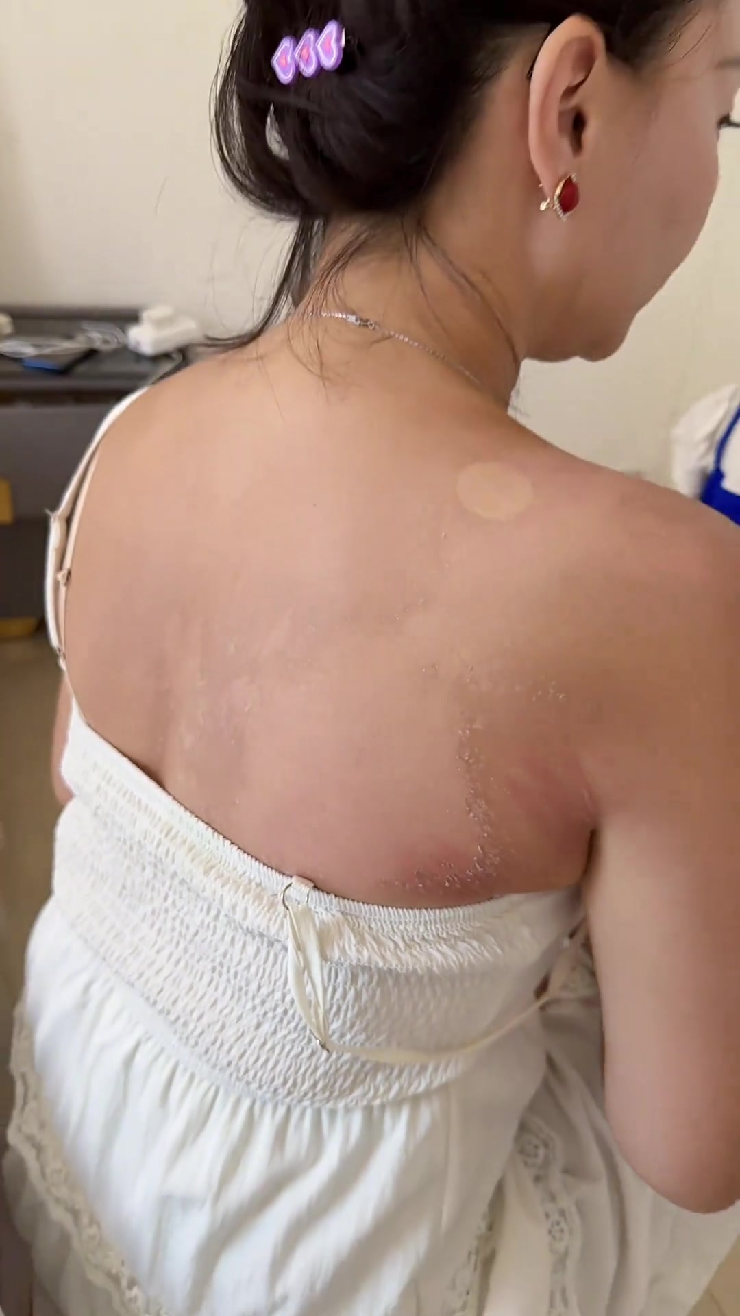 大家关心我的晒伤皮肤,现在好多了,分享恢复经历