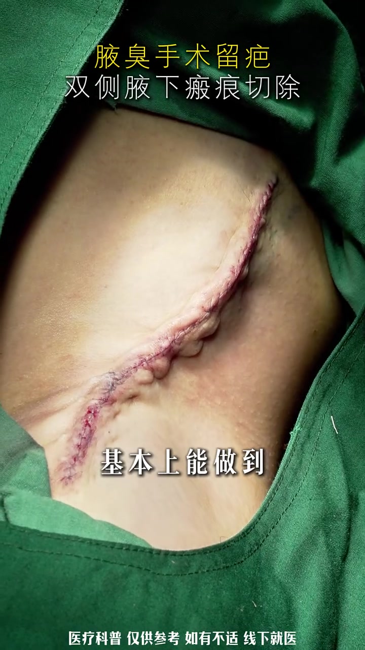 今日切除|传统腋臭手术留下的疤痕 腋下疤痕 腋下疤痕修复