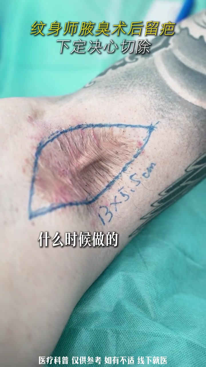 关于腋下的"秘密",手术前有些话想说